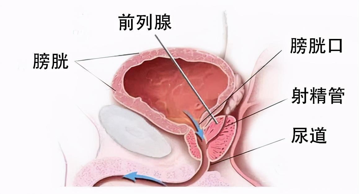 前列腺炎最新治疗技术，健康之门的解锁密钥